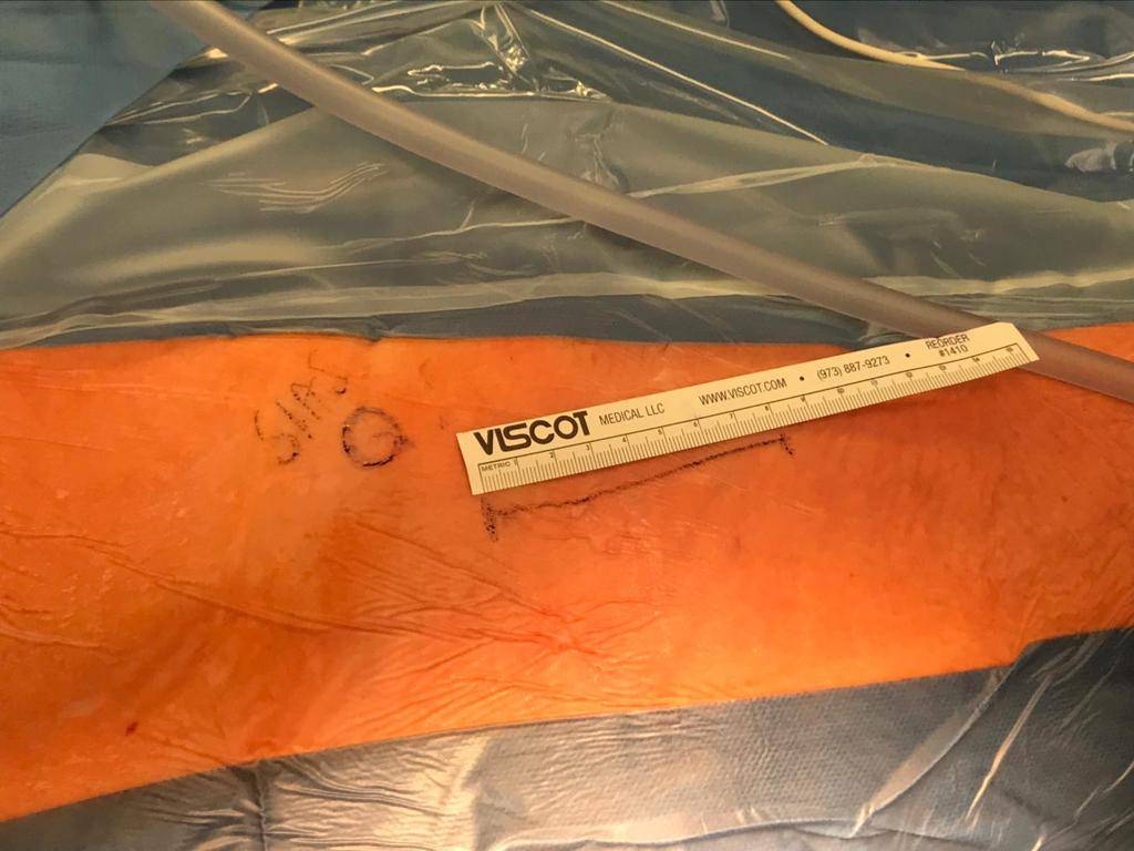 Die Schnitte bei der minimal-invasiven Eingriffstechnik sind zwischen 7 und 10 cm lang....
