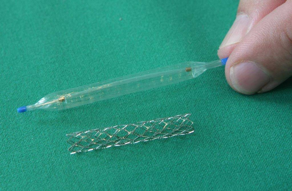 Stent: „Ein Stent ist eine implantierbare...